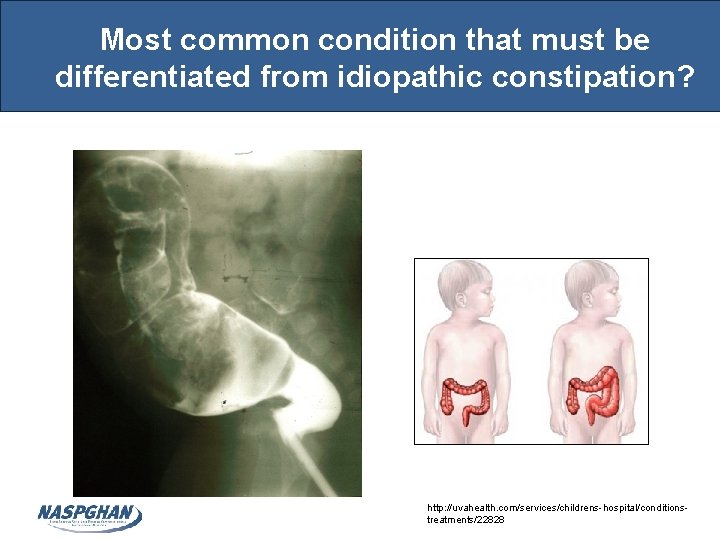 Most common condition that must be differentiated from idiopathic constipation? http: //uvahealth. com/services/childrens-hospital/conditionstreatments/22828 