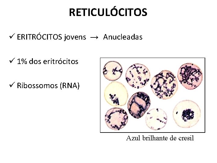 RETICULÓCITOS ü ERITRÓCITOS jovens → Anucleadas ü 1% dos eritrócitos ü Ribossomos (RNA) Azul