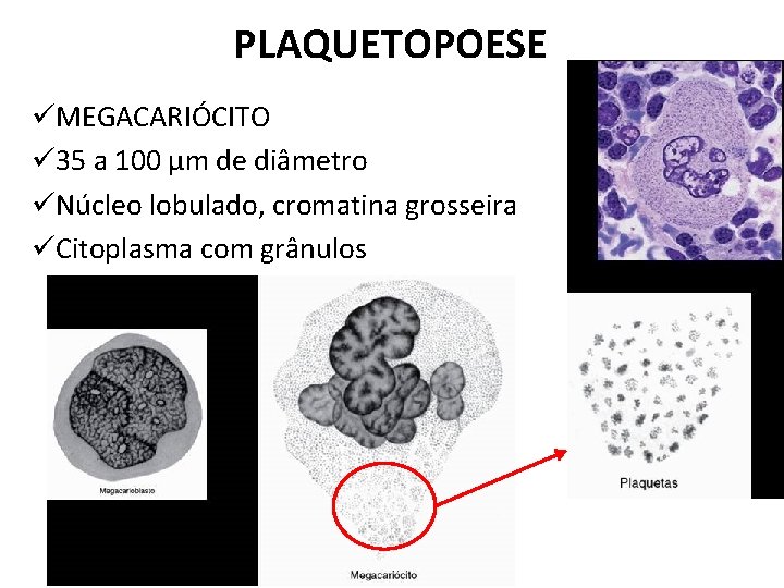 PLAQUETOPOESE üMEGACARIÓCITO ü 35 a 100 µm de diâmetro üNúcleo lobulado, cromatina grosseira üCitoplasma