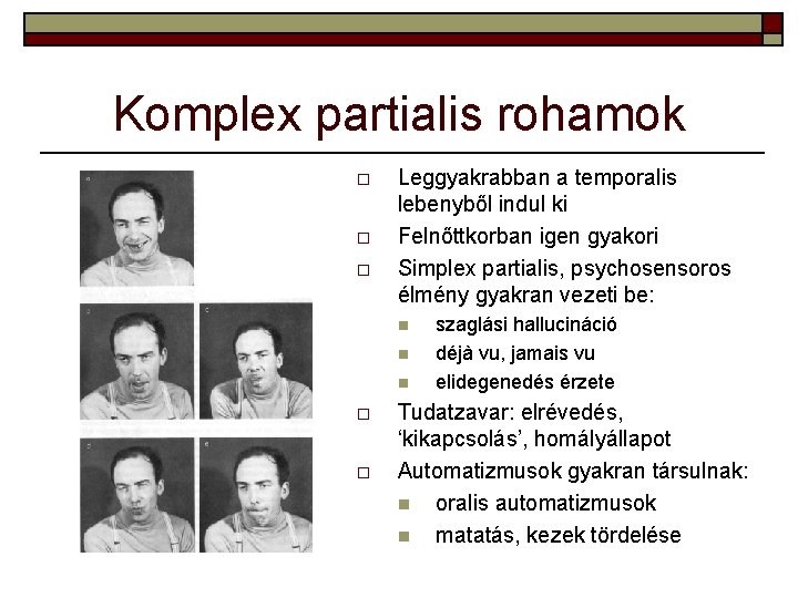 Komplex partialis rohamok o o o Leggyakrabban a temporalis lebenyből indul ki Felnőttkorban igen Komplex partialis rohamok o o o Leggyakrabban a temporalis lebenyből indul ki Felnőttkorban igen