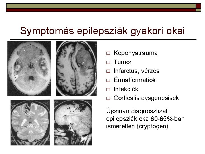 Symptomás epilepsziák gyakori okai o o o Koponyatrauma Tumor Infarctus, vérzés Érmalformatiok Infekciók Corticalis