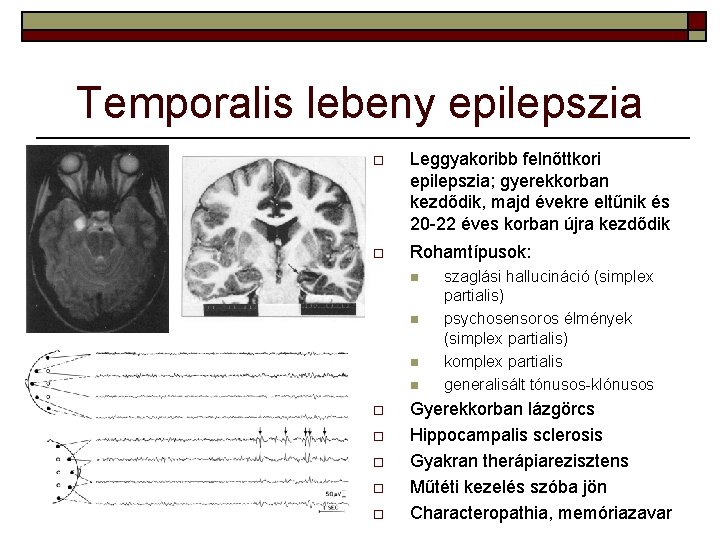 Temporalis lebeny epilepszia o Leggyakoribb felnőttkori epilepszia; gyerekkorban kezdődik, majd évekre eltűnik és 20 Temporalis lebeny epilepszia o Leggyakoribb felnőttkori epilepszia; gyerekkorban kezdődik, majd évekre eltűnik és 20