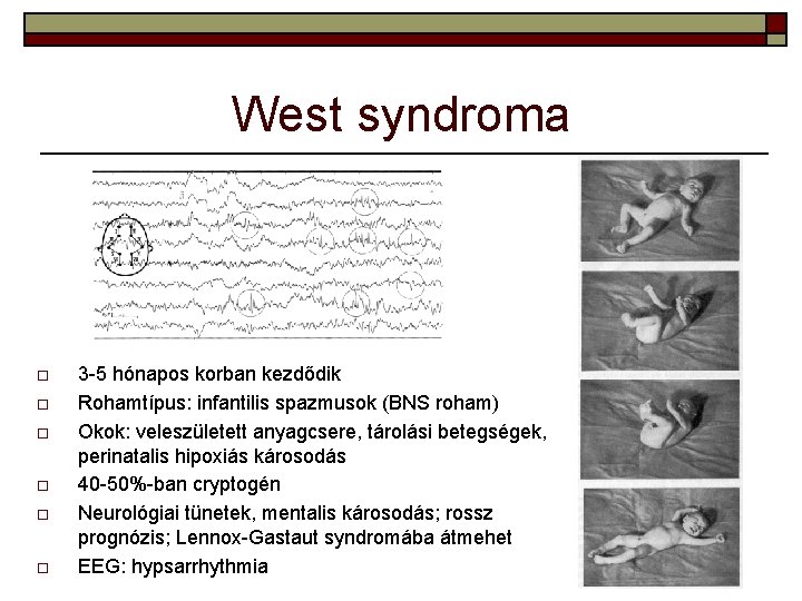 West syndroma o o o 3 -5 hónapos korban kezdődik Rohamtípus: infantilis spazmusok (BNS