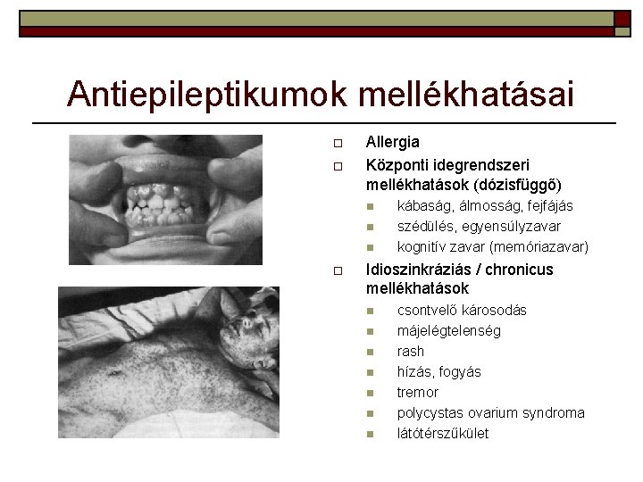 Antiepileptikumok mellékhatásai o o Allergia Központi idegrendszeri mellékhatások (dózisfüggő) n n n o kábaság,