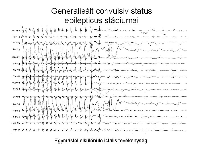 Generalisált convulsiv status epilepticus stádiumai Egymástól elkülönülő ictalis tevékenység 