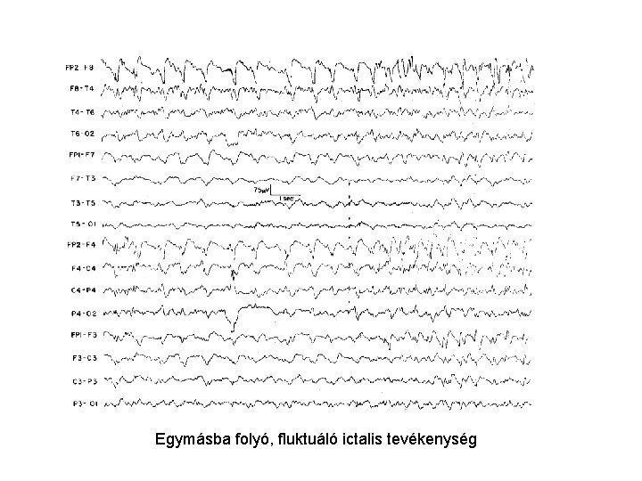 Egymásba folyó, fluktuáló ictalis tevékenység 