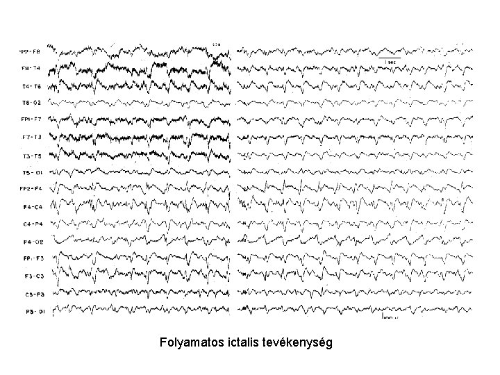 Folyamatos ictalis tevékenység 