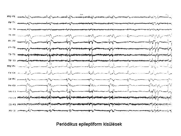 Periódikus epileptiform kisülések 