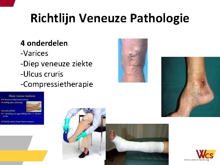 Richtlijn Veneuze Pathologie 4 onderdelen -Varices -Diep veneuze ziekte -Ulcus cruris -Compressietherapie 