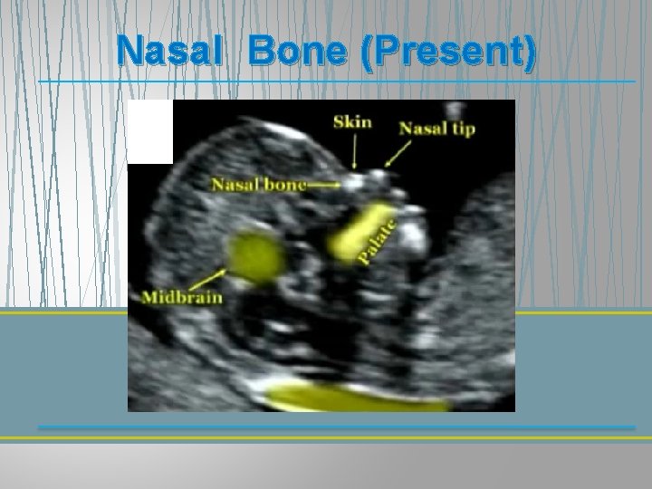 Nasal Bone (Present) Nasal Bone (Present)