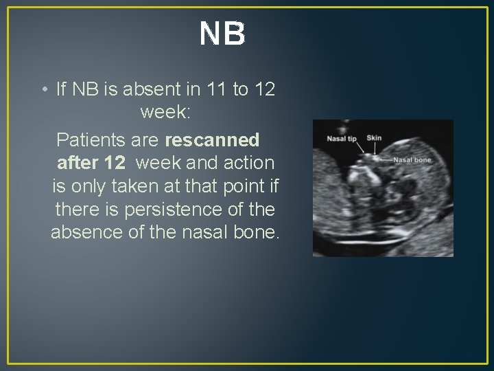 NB • If NB is absent in 11 to 12 week: Patients are rescanned NB • If NB is absent in 11 to 12 week: Patients are rescanned