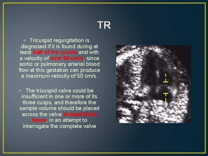TR • Tricuspid regurgitation is diagnosed if it is found during at least half TR • Tricuspid regurgitation is diagnosed if it is found during at least half