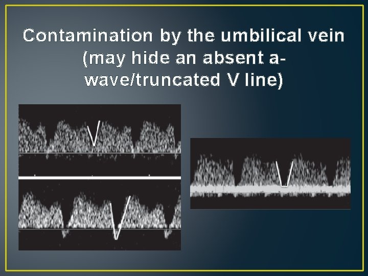 Contamination by the umbilical vein (may hide an absent awave/truncated V line) Contamination by the umbilical vein (may hide an absent awave/truncated V line)