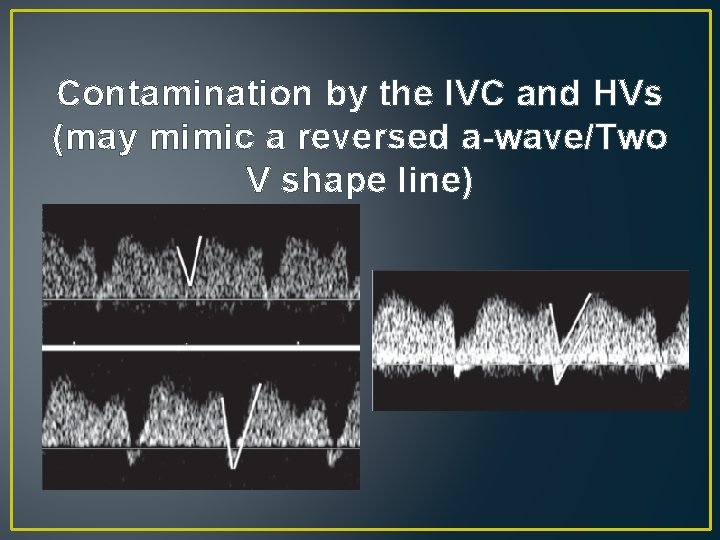 Contamination by the IVC and HVs (may mimic a reversed a-wave/Two V shape line) Contamination by the IVC and HVs (may mimic a reversed a-wave/Two V shape line)