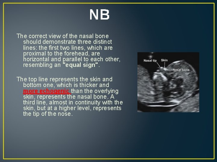 NB The correct view of the nasal bone should demonstrate three distinct lines: the NB The correct view of the nasal bone should demonstrate three distinct lines: the