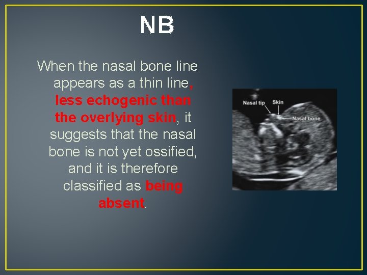 NB When the nasal bone line appears as a thin line, less echogenic than NB When the nasal bone line appears as a thin line, less echogenic than