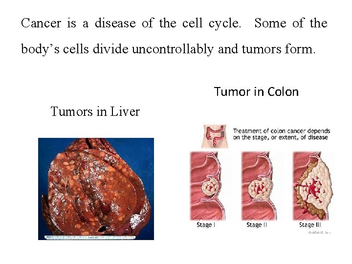 Cancer is a disease of the cell cycle. Some of the body’s cells divide