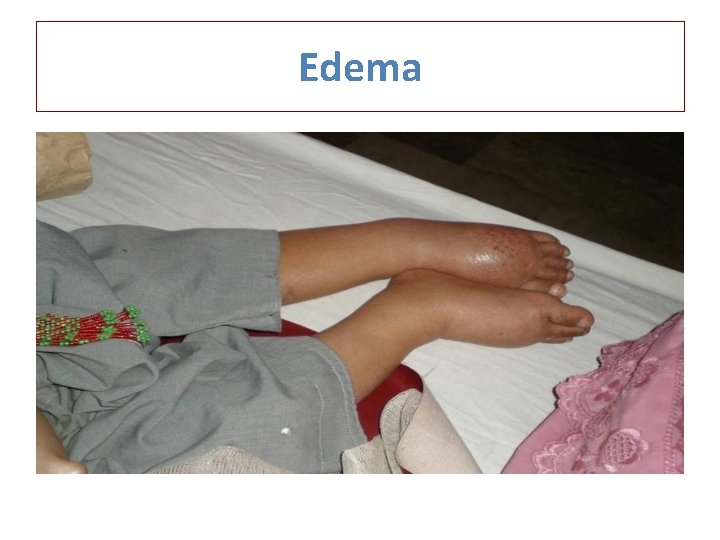 Edema 