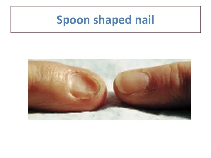 Spoon shaped nail 