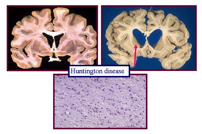 Huntington disease 