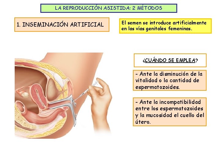 LA REPRODUCCIÓN ASISTIDA: 2 MÉTODOS 1. INSEMINACIÓN ARTIFICIAL El semen se introduce artificialmente en