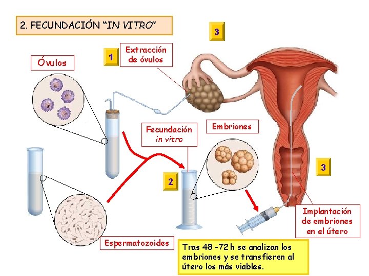 2. FECUNDACIÓN “IN VITRO” Óvulos 1 1 2 3 Extracción de óvulos Fecundación in