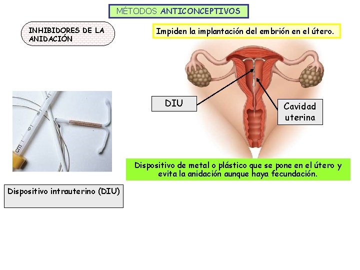 MÉTODOS ANTICONCEPTIVOS INHIBIDORES DE LA ANIDACIÓN Impiden la implantación del embrión en el útero.