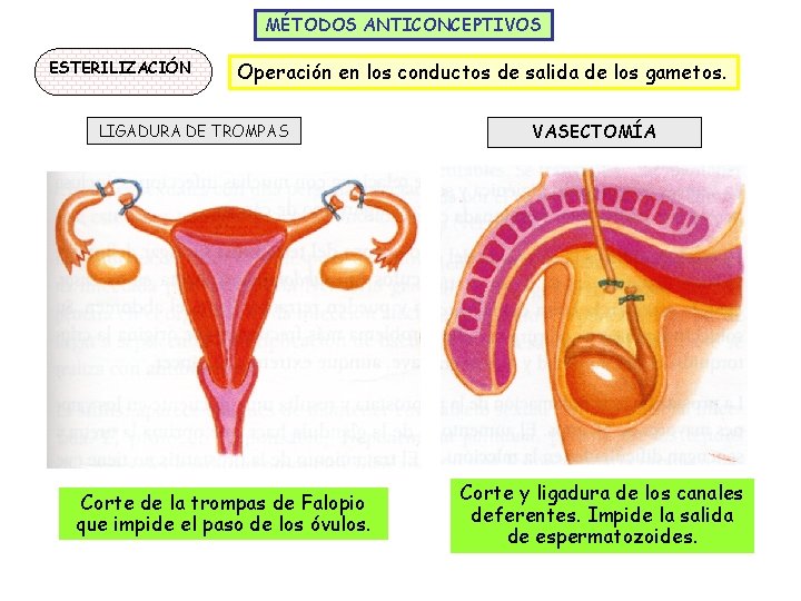 MÉTODOS ANTICONCEPTIVOS ESTERILIZACIÓN Operación en los conductos de salida de los gametos. LIGADURA DE