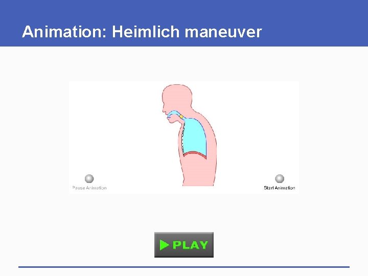 Animation: Heimlich maneuver 