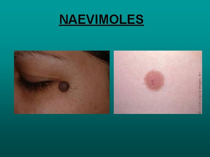 NAEVIMOLES 