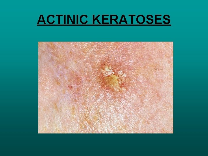 ACTINIC KERATOSES 