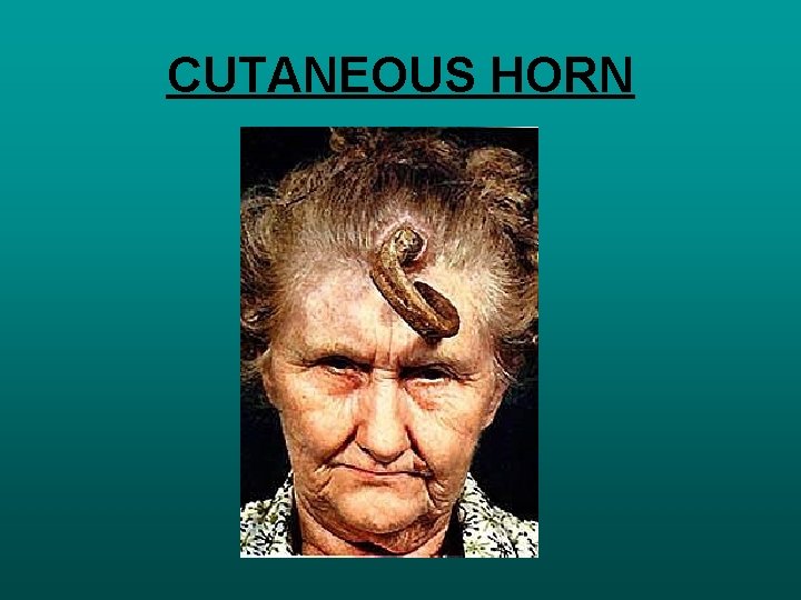 CUTANEOUS HORN 