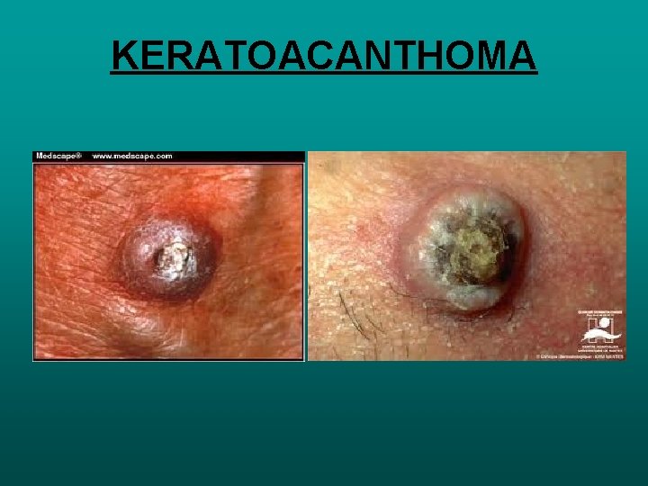 KERATOACANTHOMA 