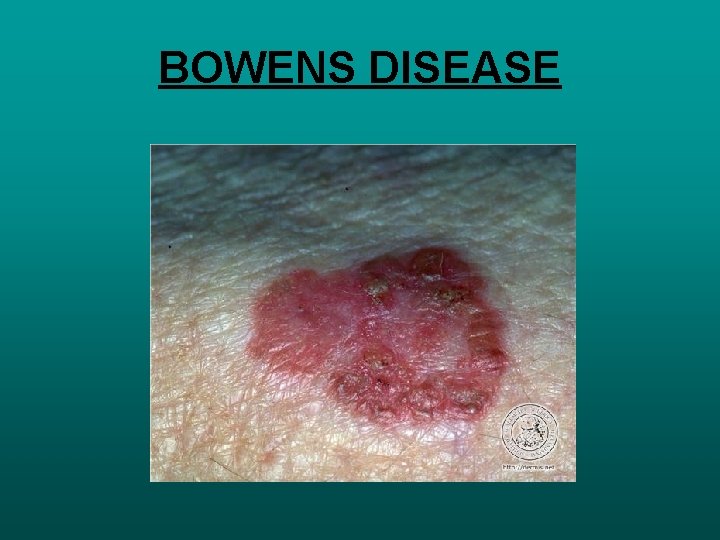 BOWENS DISEASE 