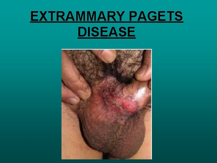 EXTRAMMARY PAGETS DISEASE 