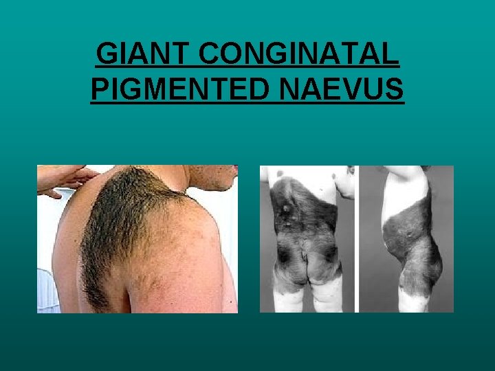 GIANT CONGINATAL PIGMENTED NAEVUS 