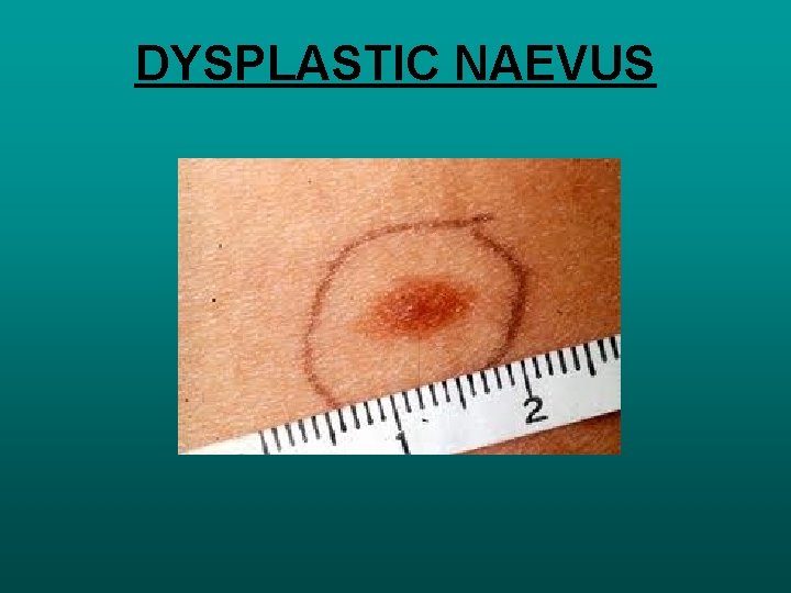 DYSPLASTIC NAEVUS 