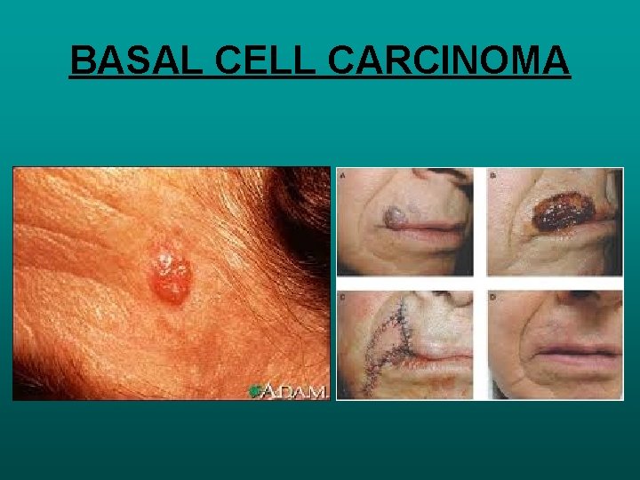BASAL CELL CARCINOMA 