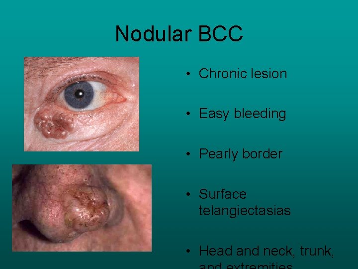 Nodular BCC • Chronic lesion • Easy bleeding • Pearly border • Surface telangiectasias