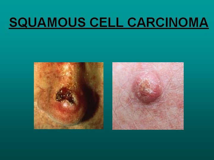 SQUAMOUS CELL CARCINOMA 