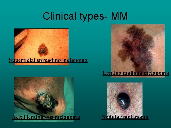 Clinical types- MM Superficial spreading melanoma Lentigo maligna melanoma Acral lentiginous melanoma Nodular melanoma
