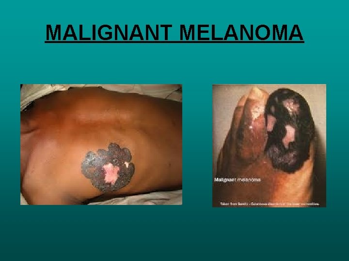 MALIGNANT MELANOMA 