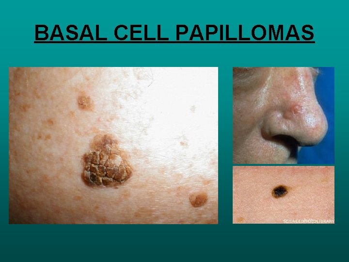 BASAL CELL PAPILLOMAS 