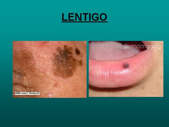 LENTIGO 