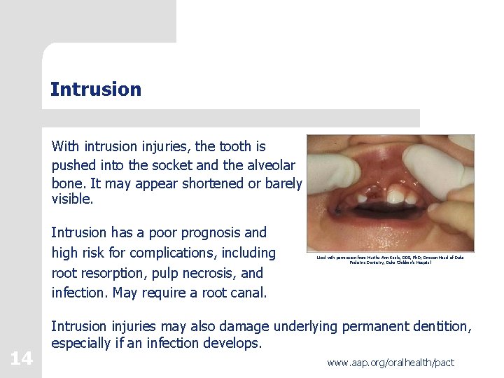 Intrusion With intrusion injuries, the tooth is pushed into the socket and the alveolar