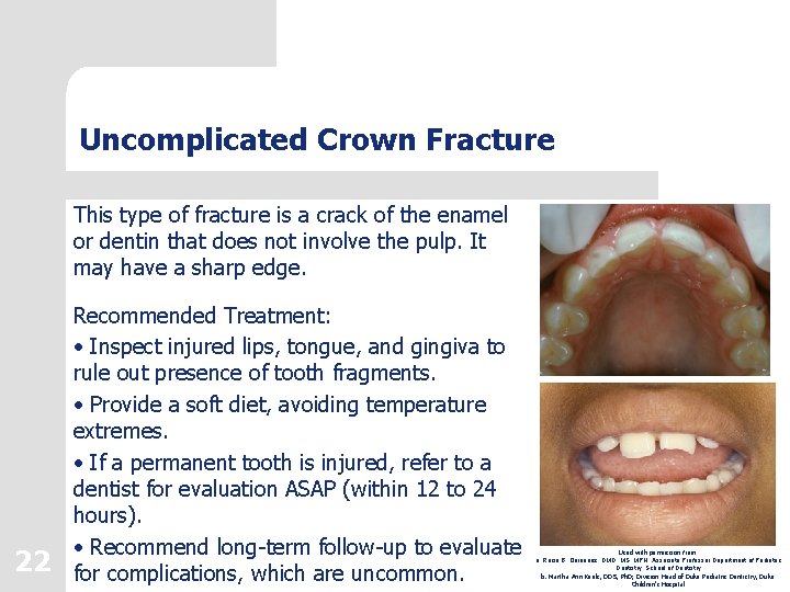 Uncomplicated Crown Fracture This type of fracture is a crack of the enamel or