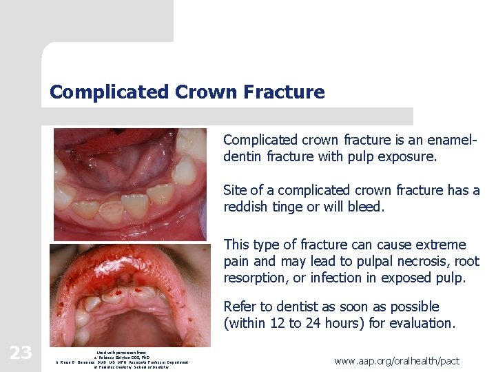 Complicated Crown Fracture Complicated crown fracture is an enameldentin fracture with pulp exposure. Site