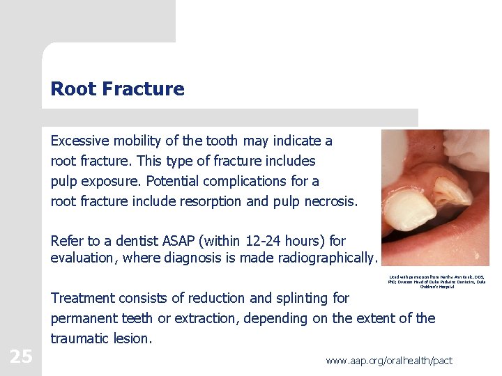 Root Fracture Excessive mobility of the tooth may indicate a root fracture. This type