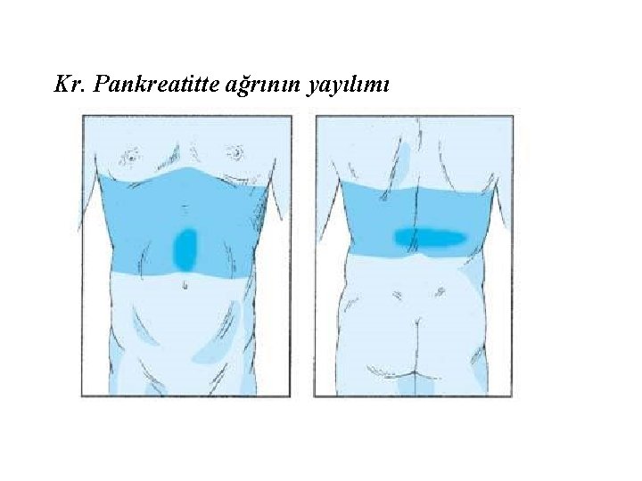 Kr. Pankreatitte ağrının yayılımı 