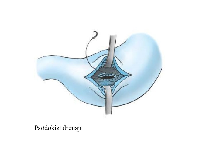 Psödokist drenajı 